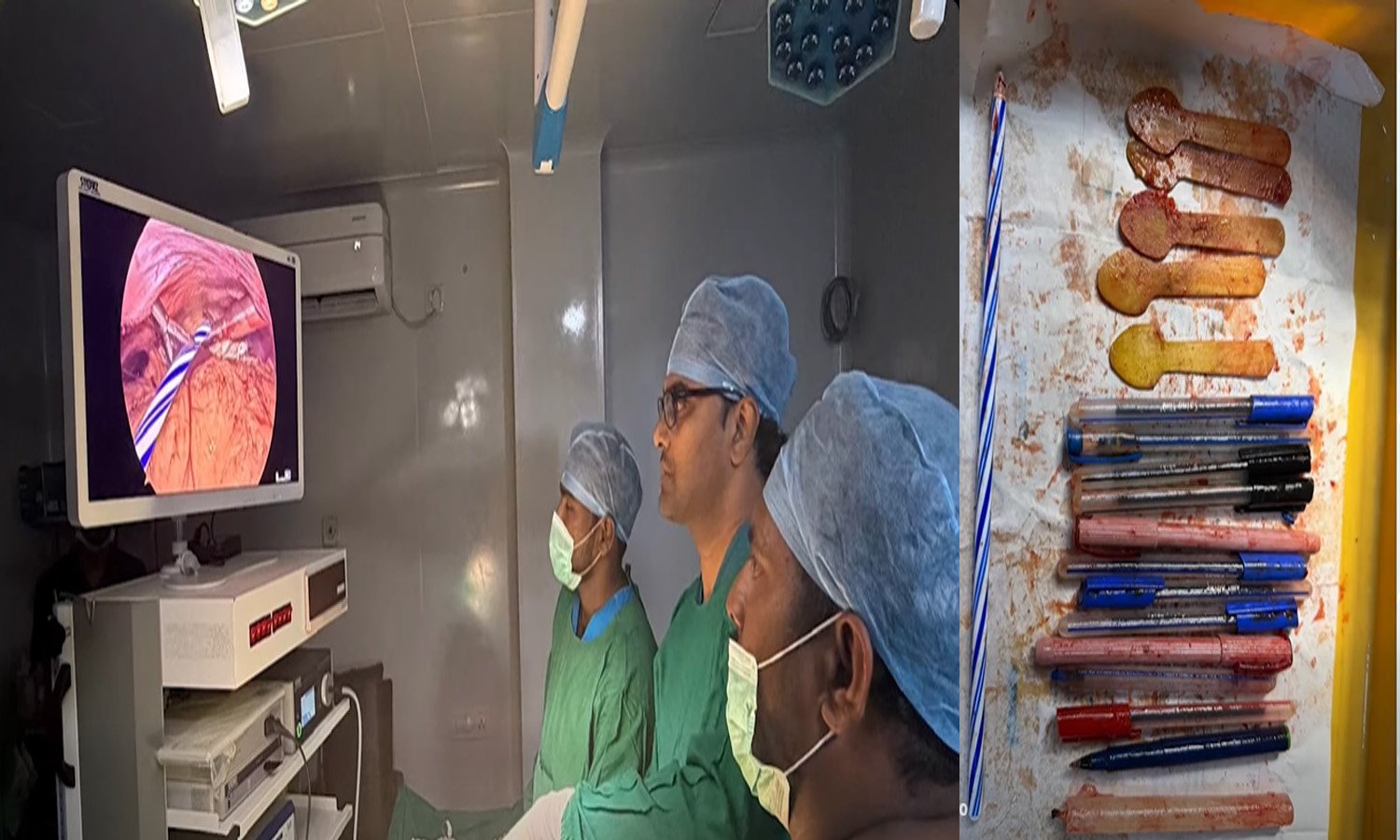 Medical Case in Andhra Pradesh Pens and Wooden Spoons Found Inside Woman’s Stomach